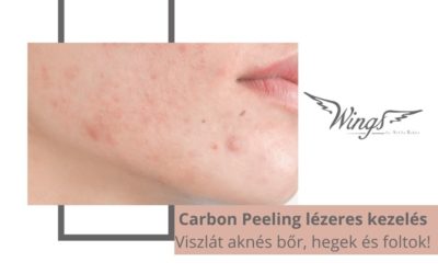 Carbon Peeling lézeres kezelés – Viszlát aknés bőr, hegek és foltok!